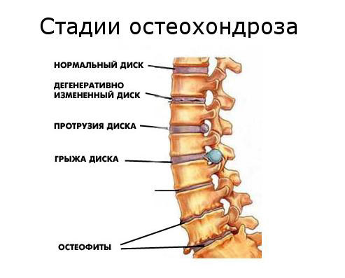 Как определить шейный остеохондроз и как лечить Как определить шейный остеохондроз и как лечить