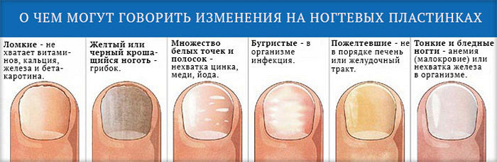Виды ногтей на ногах Виды ногтей на ногах
