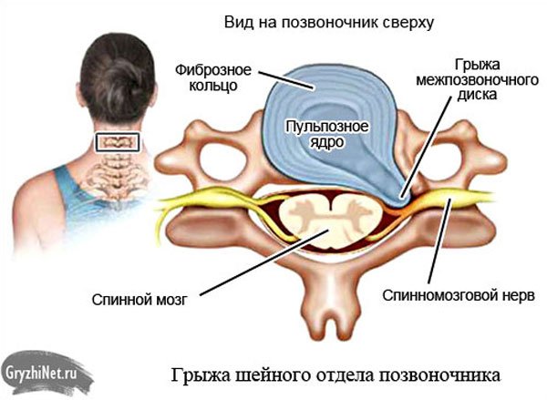 Лечение остеохондроза шейного позвонка народными средствами Лечение остеохондроза шейного позвонка народными средствами