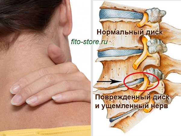 Когда остеохондроз запущенный как вылечить Когда остеохондроз запущенный как вылечить