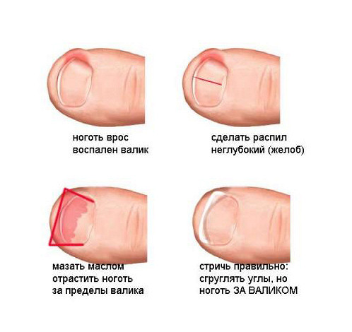 Грибок и вросший ноготь Грибок и вросший ноготь