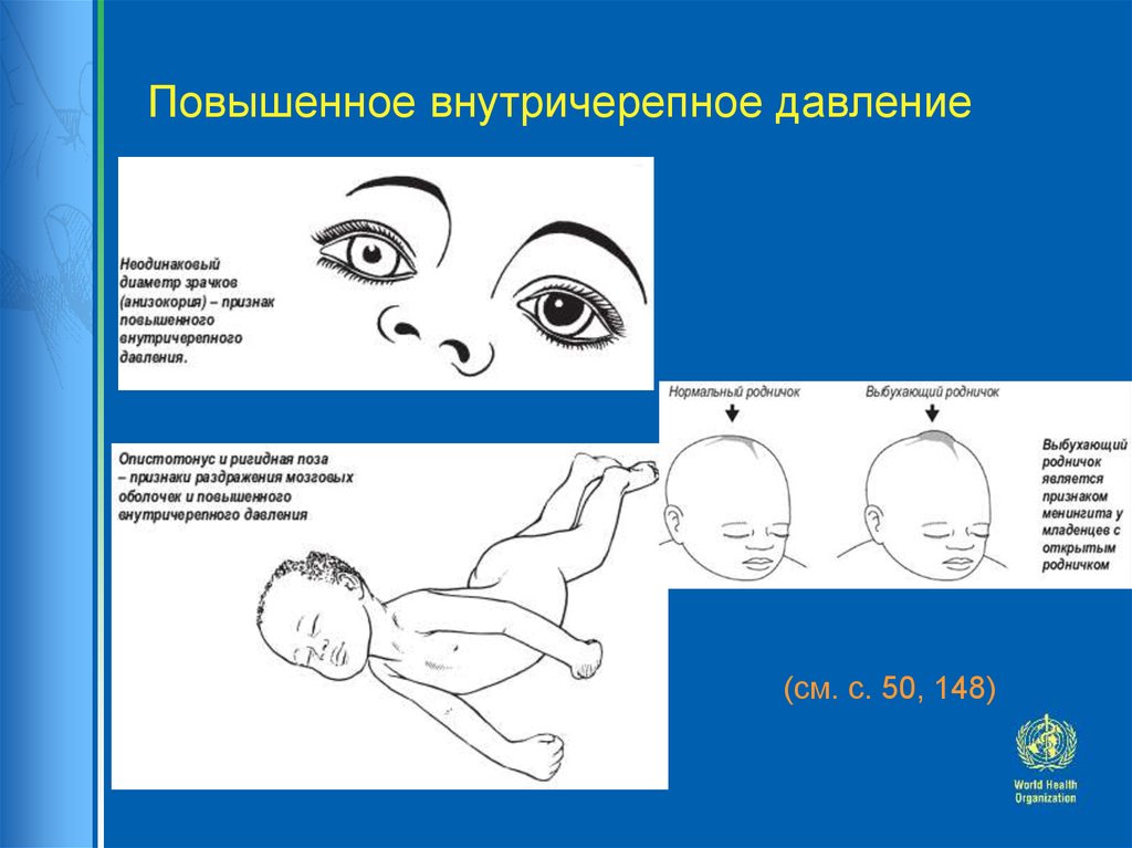 Внутричерепное давление на глаза как лечить Внутричерепное давление на глаза как лечить