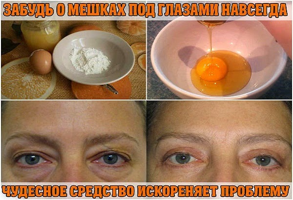 Снять мешки под глазами в домашних условиях