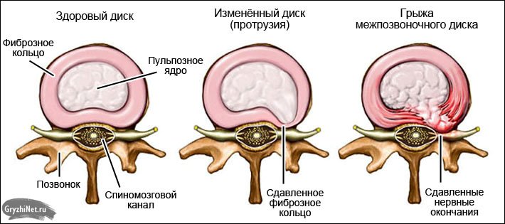 Начинающая грыжа позвоночника лечение Начинающая грыжа позвоночника лечение