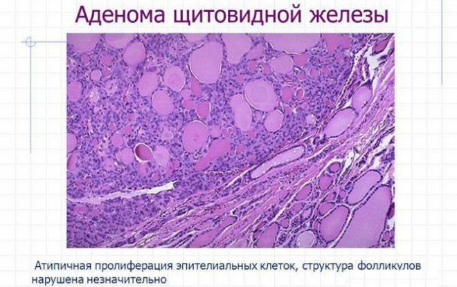 Что такое аденома у женщин в молочных железах Что такое аденома у женщин в молочных железах