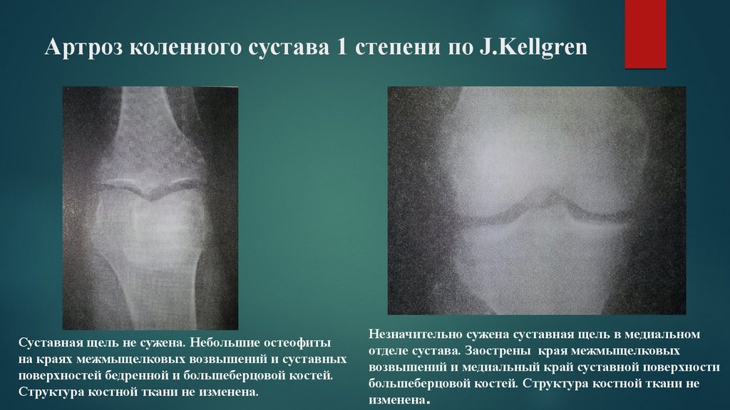 Артроз коленных суставов рецепты лечения Артроз коленных суставов рецепты лечения
