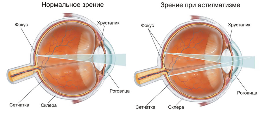 Зрение 4 какие линзы нужны