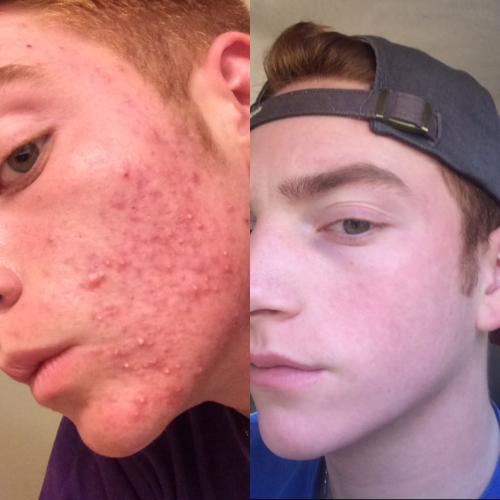 40mg of accutane