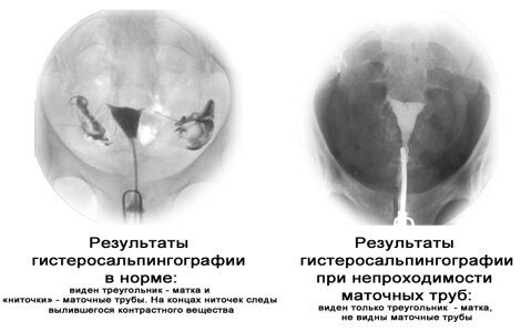 Рентгенологические методы в гинекологии